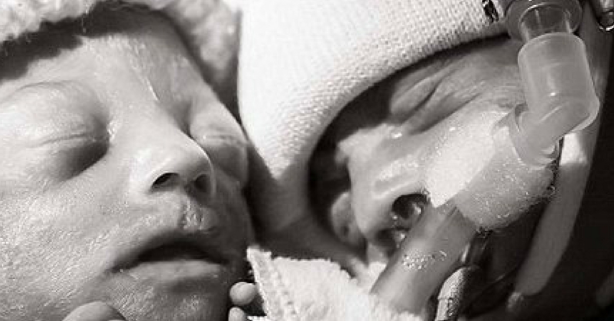 gemelli sindrome feto fetale