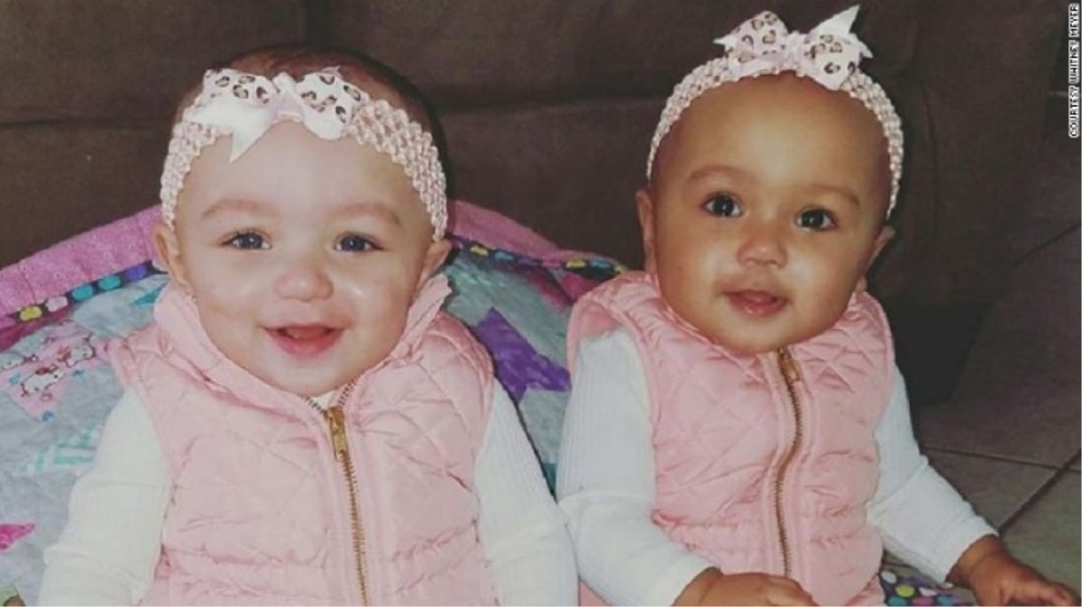 Due Gemelle Ma Di Colore Diverso Un Fenomeno Più Unico Che Raro