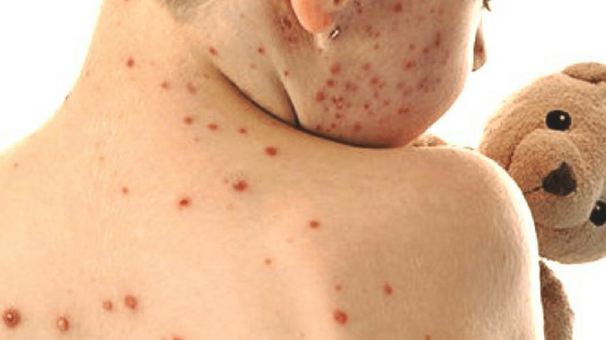 Morbillo, immagine di repertorio