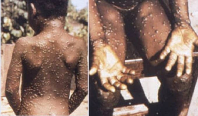 Europa: primo caso di contagio da vaiolo delle scimmie con febbre, vesciche e vomito
