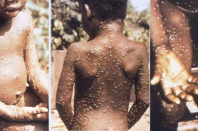 Europa: primo caso di contagio da vaiolo delle scimmie con febbre, vesciche e vomito