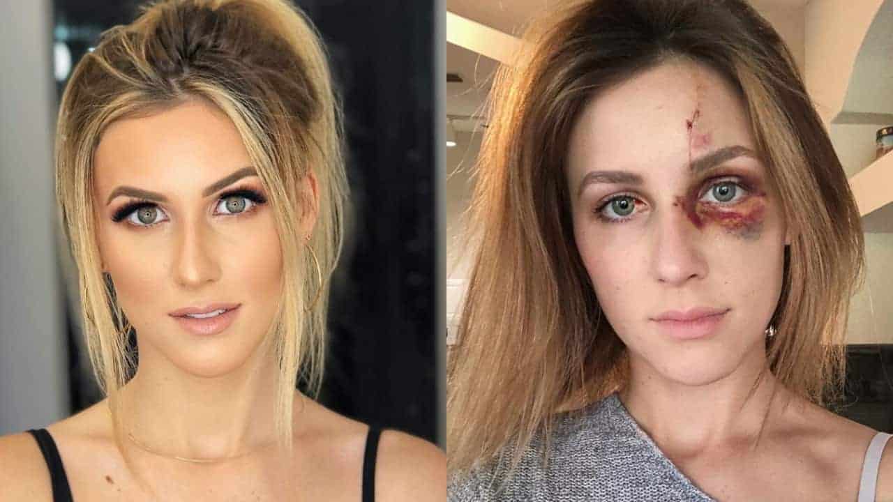 Melissa, 22 anni, picchiata dal fidanzato per una scollatura