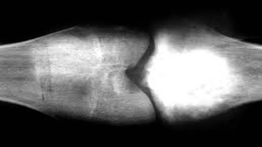 Una radiografia dell'osteosarcoma