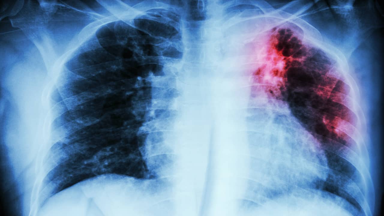 cancro ai polmoni