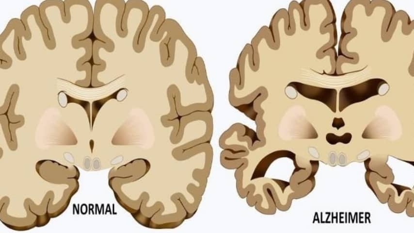 Effetti dell'Alzheimer