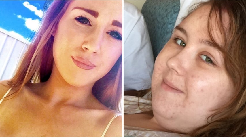 Emily prima e dopo essersi sottoposta alle cure anticancro