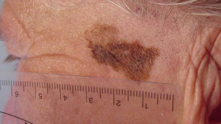 Melanoma