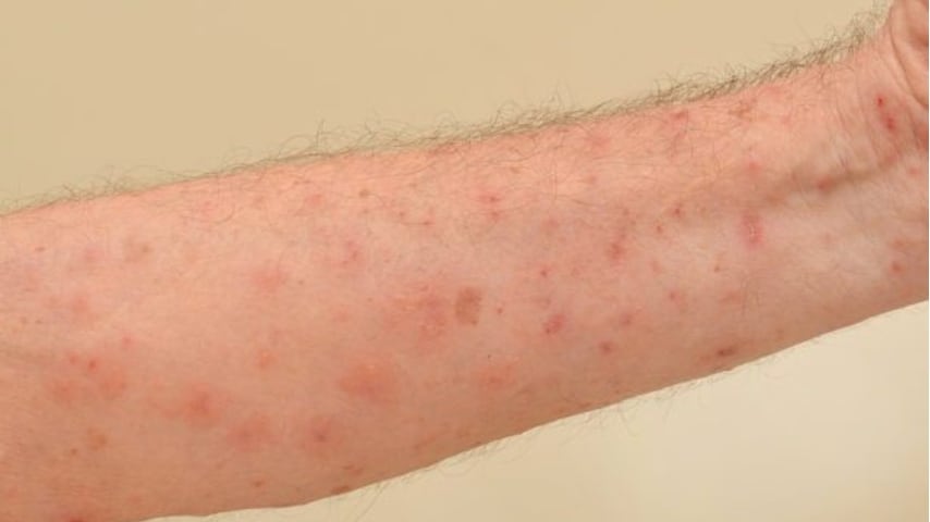 Milano, epidemia di scabbia in una casa di riposo