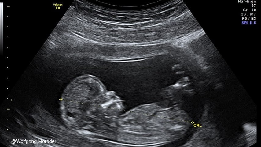 feto gravidanza