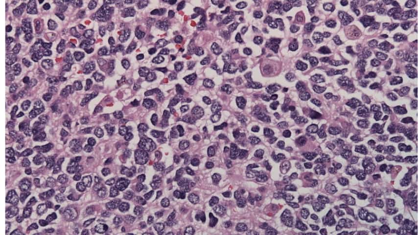 neuroblastoma cellula