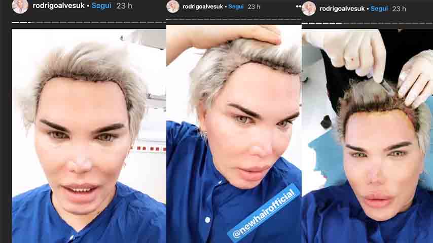 Rodrigo Alves durante il trapianto di capelli