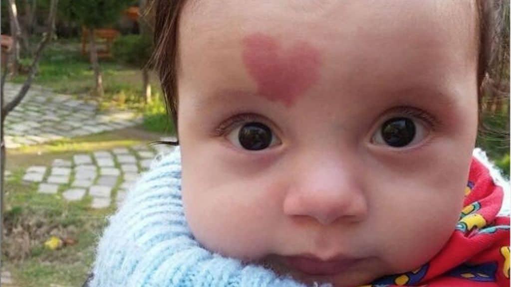 primo piano di un bimbo con una voglia a forma di cuore sulla fronte
