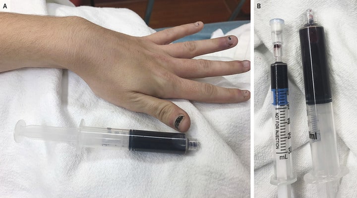 siringhe con sangue blu della paziente e mano bluastra