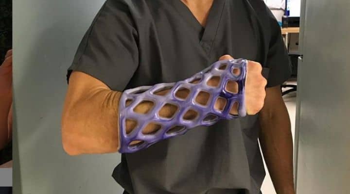 L'ingessatura in resina di Cast21