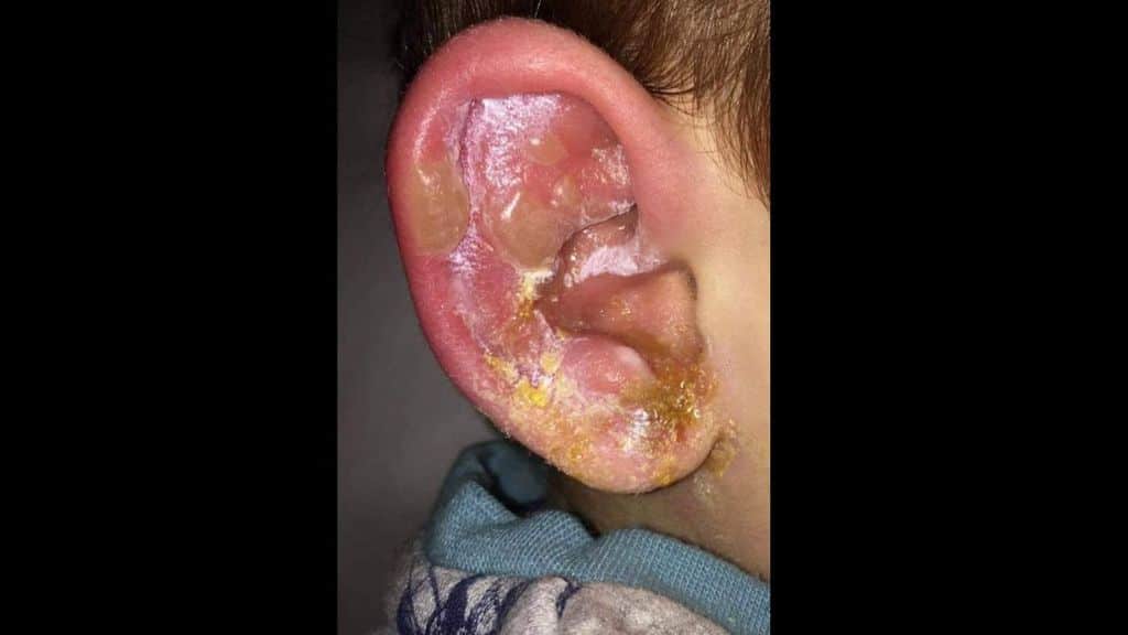 orecchio herpes