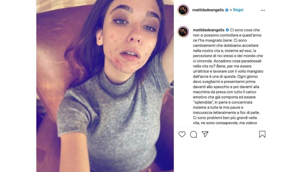 matilda de angelis acne post instagram