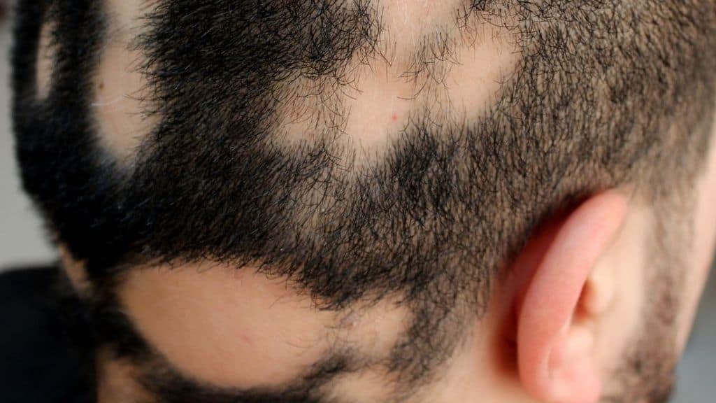 alopecia cranio uomo
