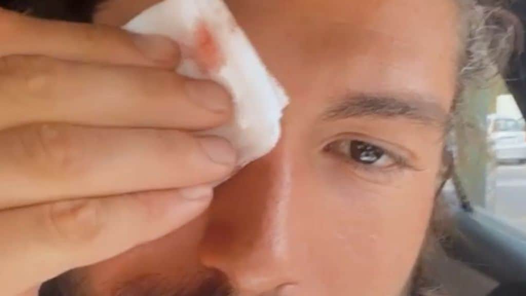 Ignazio Moser, incidente per il fidanzato di Cecilia Rodriguez: sangue e lividi sul volto, le foto su Instagram