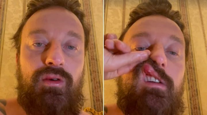 Francesco Facchinetti picchiato da Conor McGregor a Roma: “Mi ha aggredito senza motivazione”. Il racconto