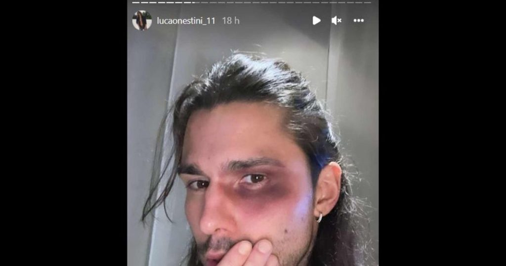 Luca Onestini si presenta ai fan con un occhio nero e parla di "triste storia": poi spiega cosa gli è successo