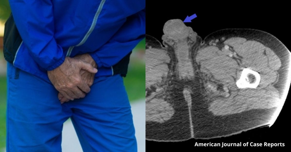 Uomo si inietta cocaina nel pene: diventa nero e ulcerato e rischia di perderlo, le parole dei medici