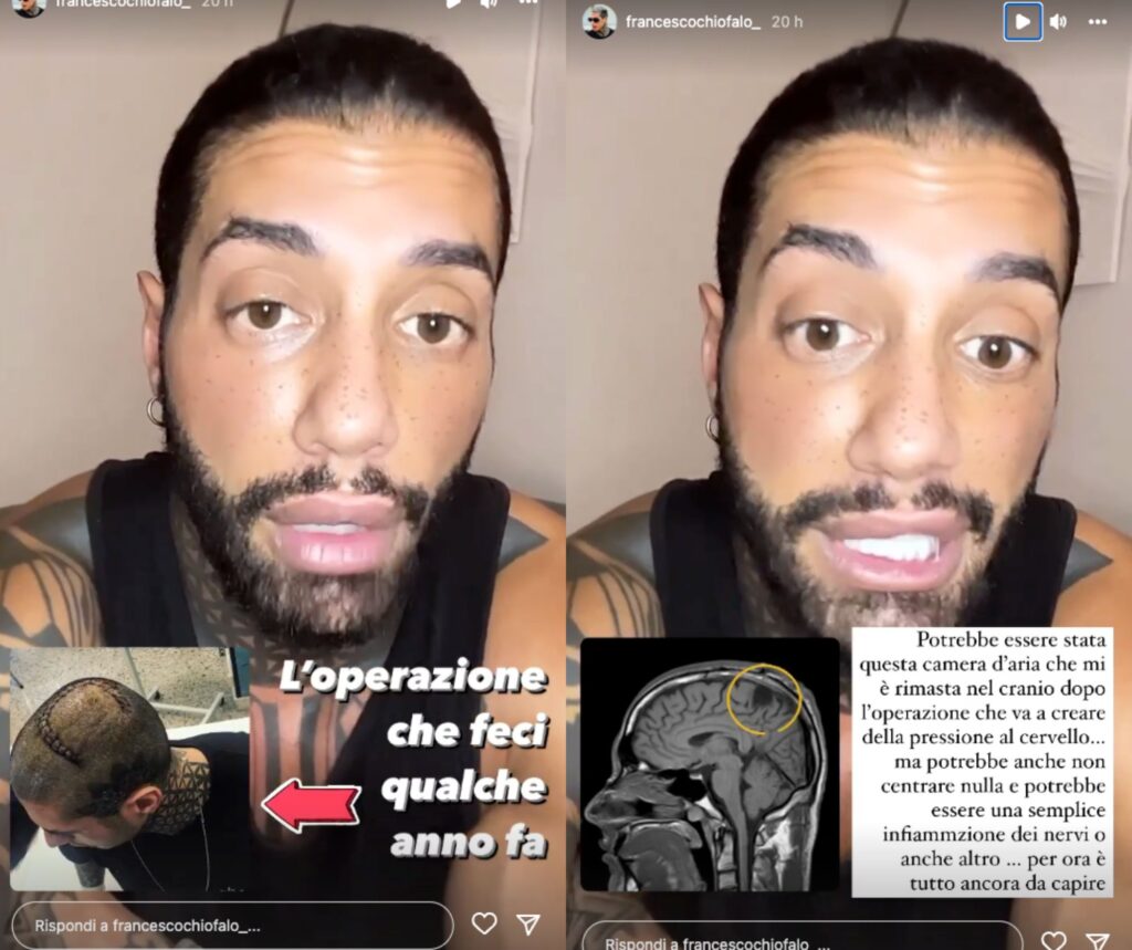 Chiofalo mostra l'operazione al cervello subita nel 2019 per un tumore