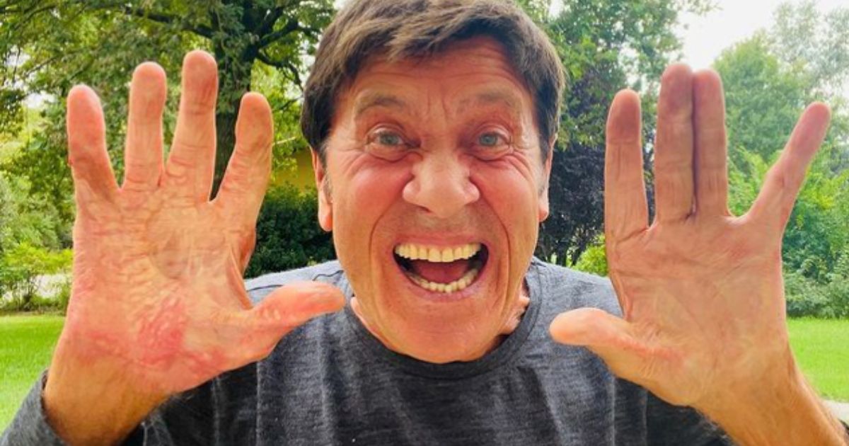 Gianni Morandi mostra le mani da vicino per la prima volta dopo l’incidente: la foto con gli effetti delle ustioni
