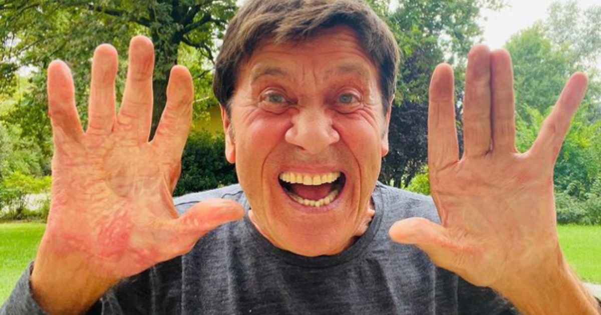 Gianni Morandi mostra le mani per la prima volta dopo l'incidente: la foto con gli effetti delle ustioni