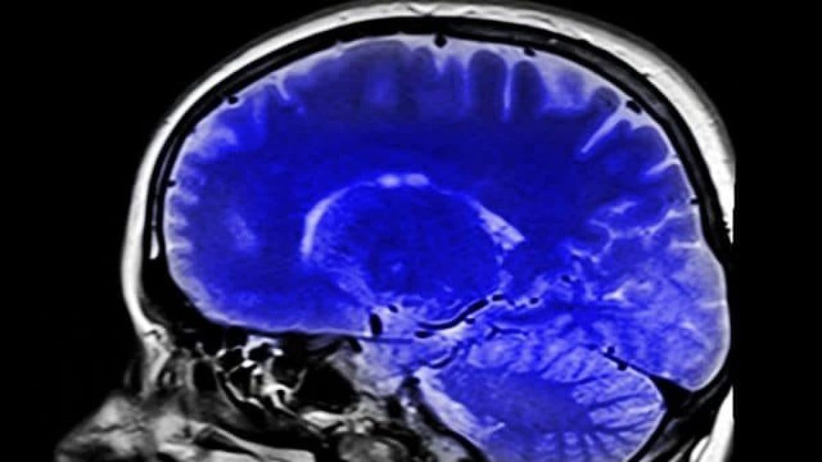 Alzheimer, uno studio chiarisce le possibili cause e apre alle speranze di cura