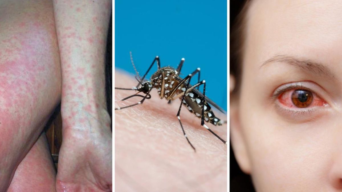 dengue Italia disinfestazione Venezia
