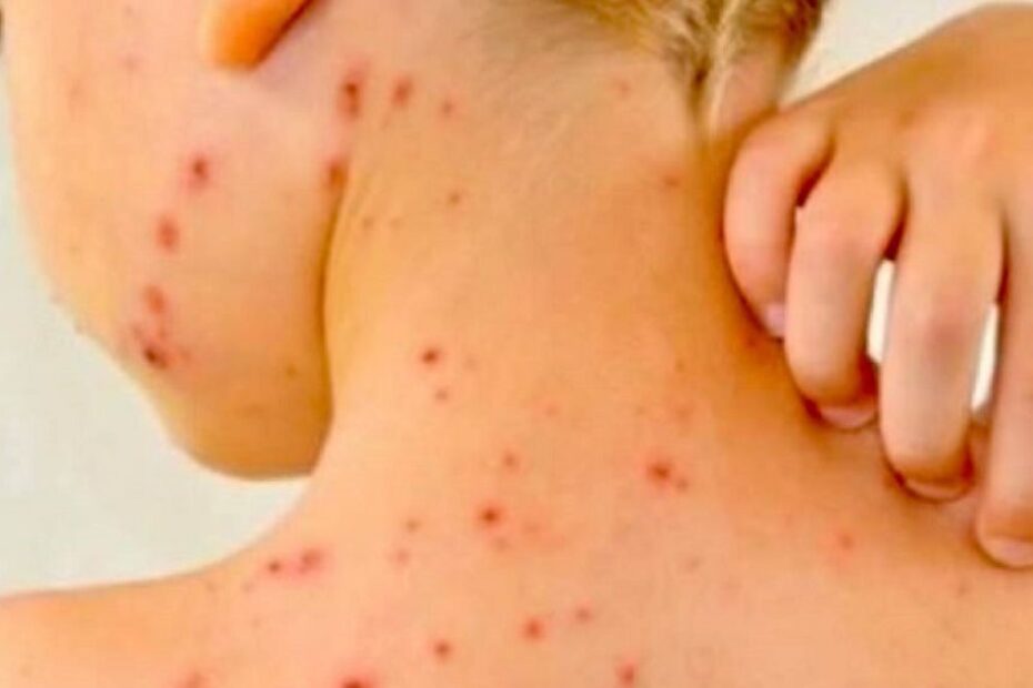 scarlattina pediatri casi cattivi