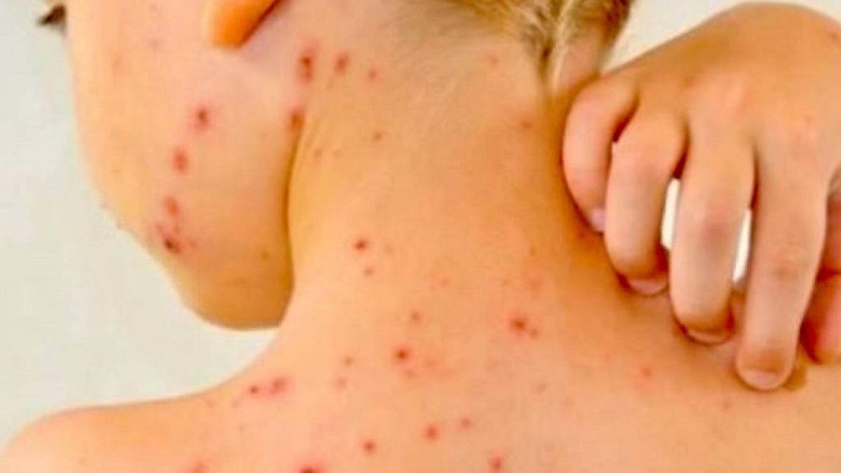 scarlattina pediatri casi cattivi