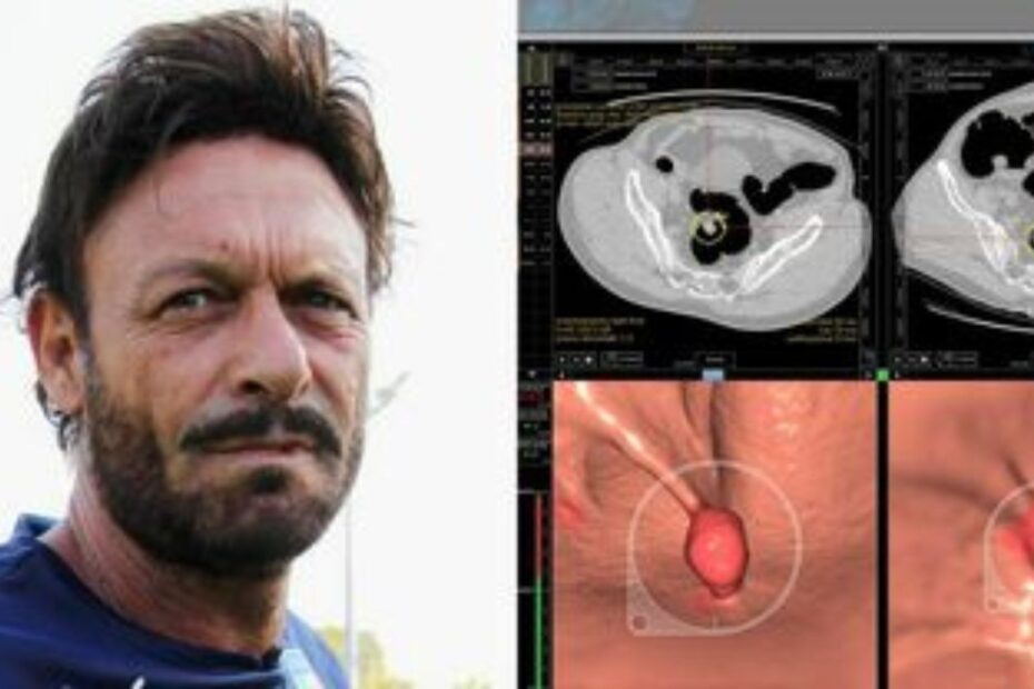 Totò Schillaci tumore colon