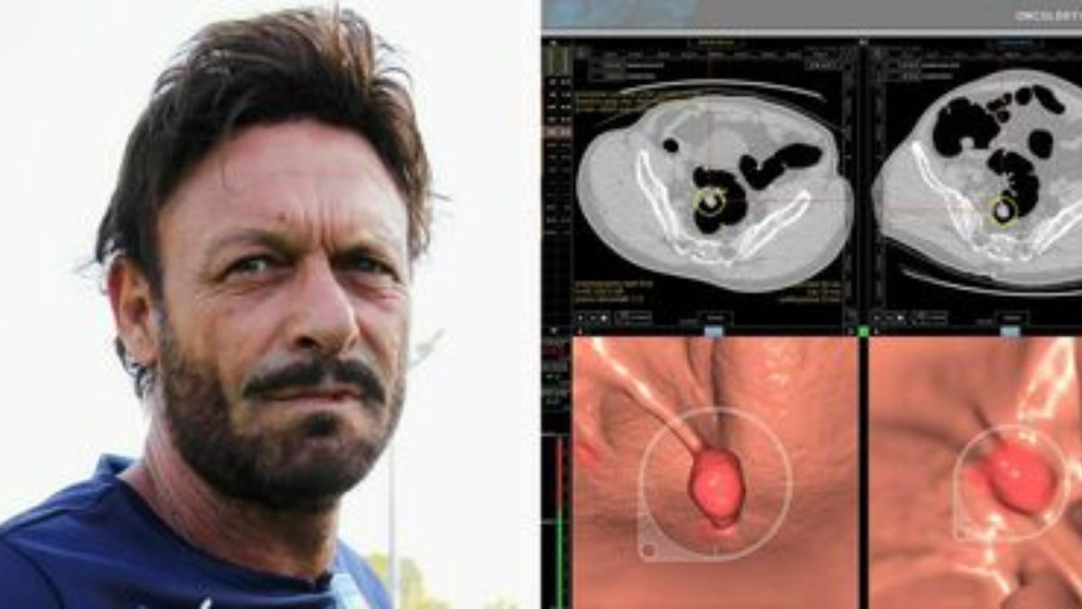 Totò Schillaci tumore colon