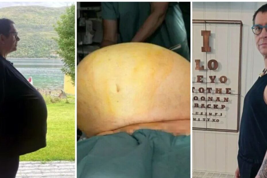 Thomas Kraut obeso tumore