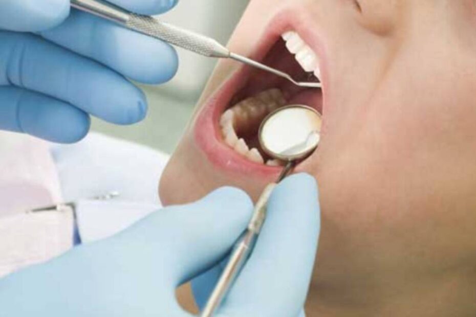 denti di gesso