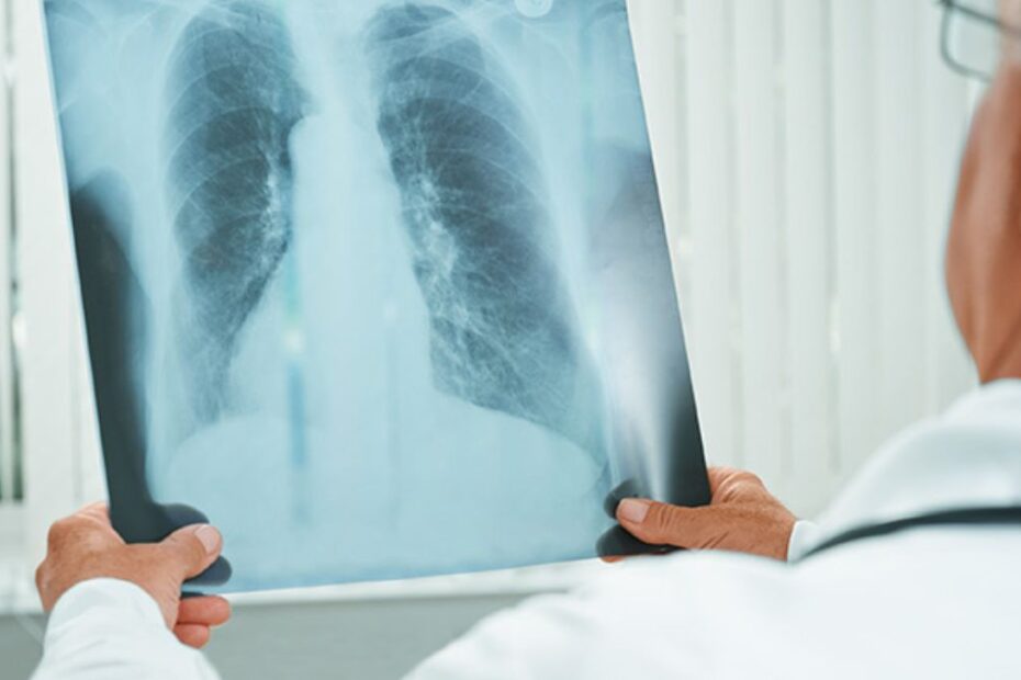 cancro polmoni non fumatori