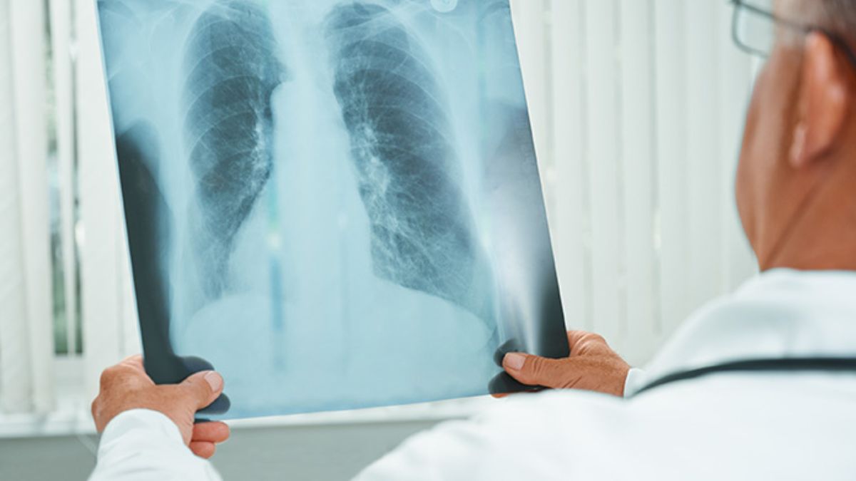 cancro polmoni non fumatori