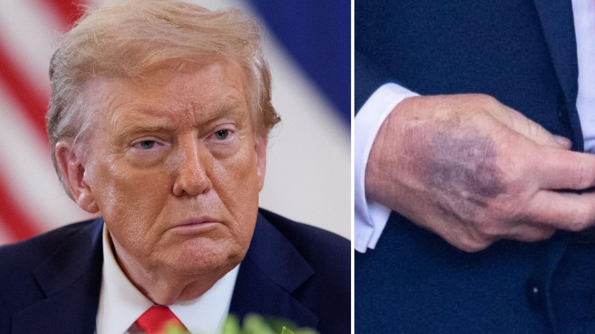Il livido sulla mano di Trump cosa significa? Quali problemi di salute può svelare Il livido sulla mano di Trump cosa significa? Quali problemi di salute può svelare