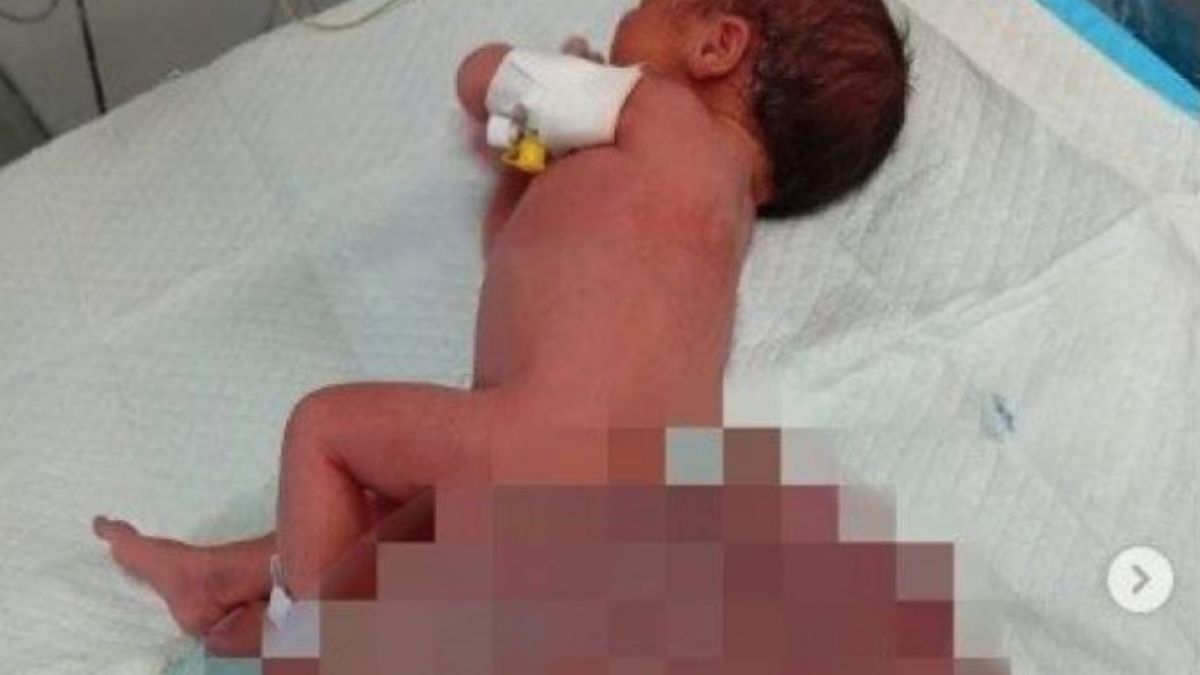 Neonata arrivata da Gaza operata all’ospedale Meyer di Firenze: asportato tumore pesante 3 volte più del suo corpo Neonata arrivata da Gaza operata all’ospedale Meyer di Firenze: asportato tumore pesante 3 volte più del suo corpo