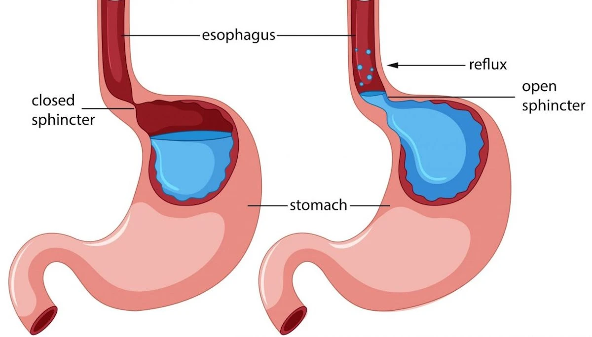 Grafico illustrativo del reflusso gastroesofageo