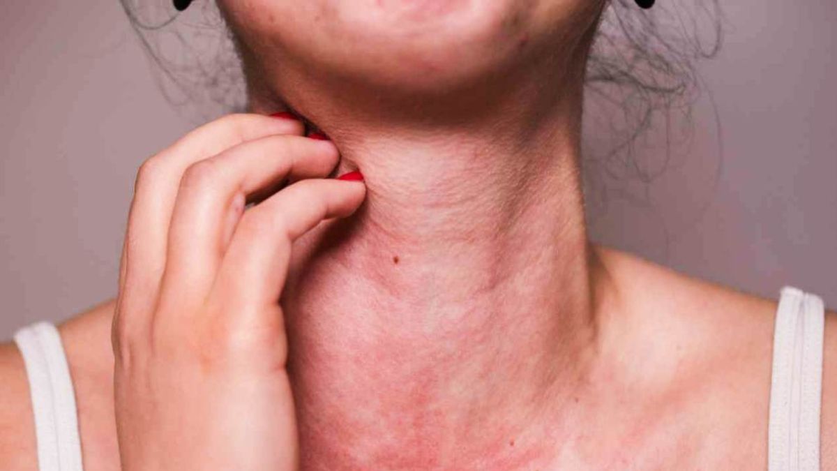 “C’è la prima vittima”. Allergia pericolosissima, si manifesta così: l’allarme degli esperti