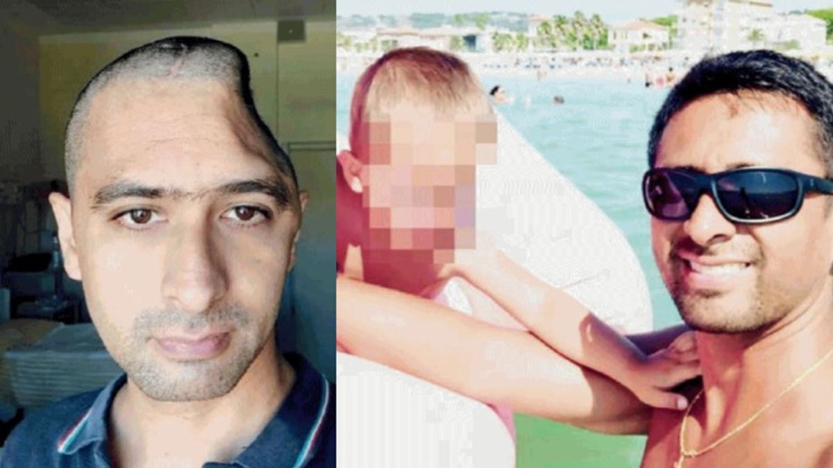 Perde un pezzo di testa in un incidente, l’assicurazione non lo risarcisce: il motivo assurdo Perde un pezzo di testa in un incidente, l’assicurazione non lo risarcisce: il motivo assurdo