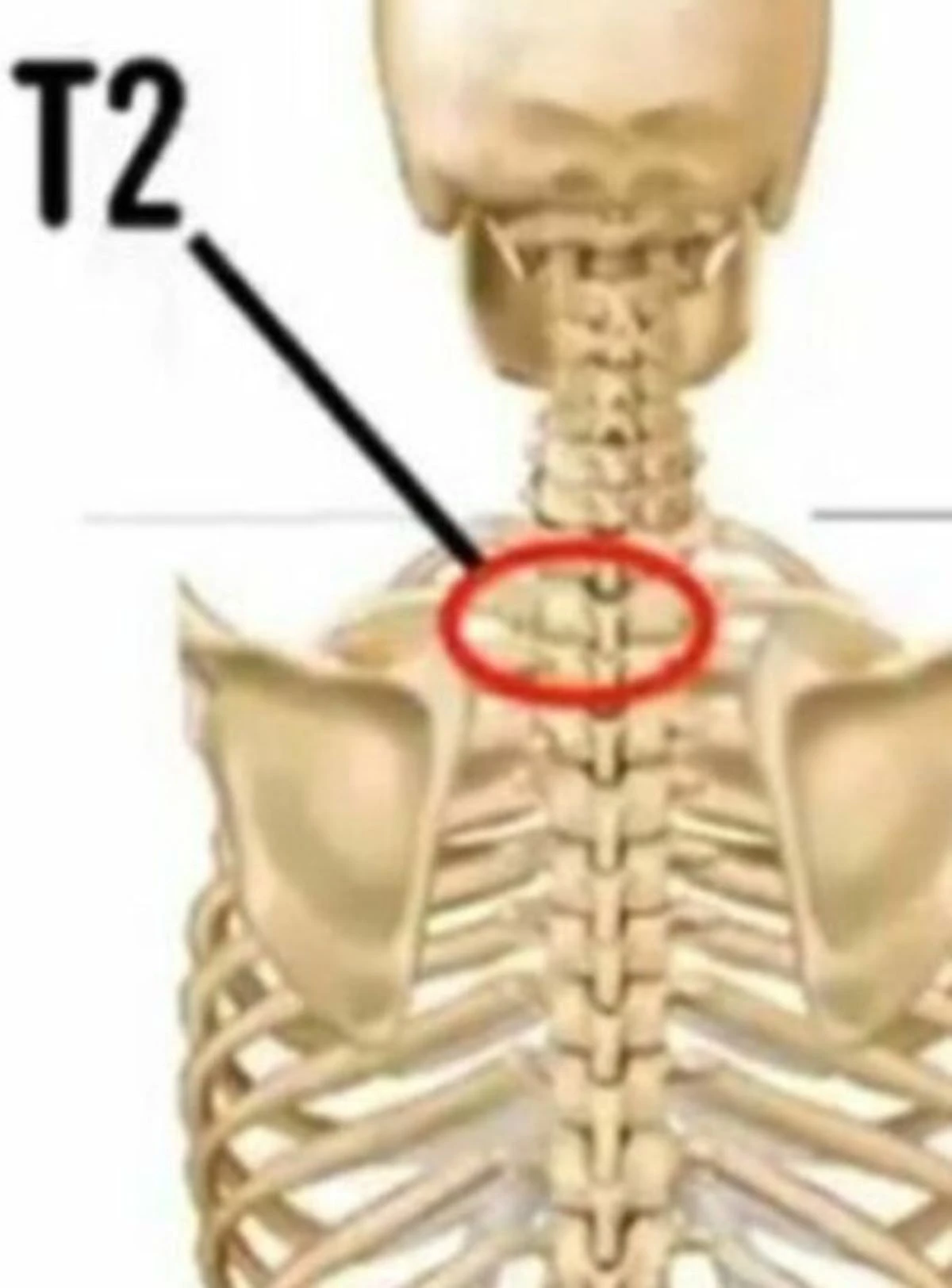 Frattura della vertebra T2 nel caso Liliana Resinovich