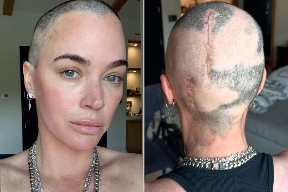 Teddi Mellencamp mostra i segni della malattia e la ricrescita dei capelli