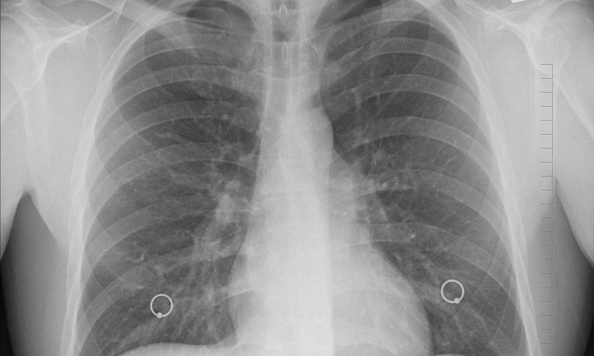 Tac che mostra una massa polmonare