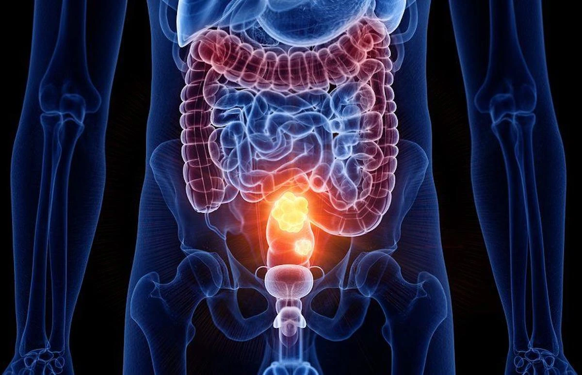 Radiografia che mostra frattura ossea