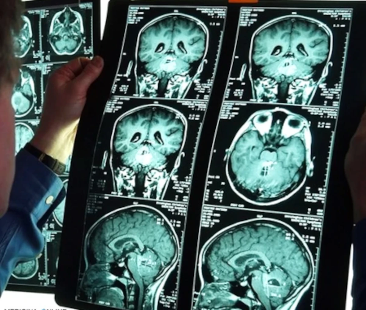 Una donna con il collo che indica instabilità cranio-cervicale