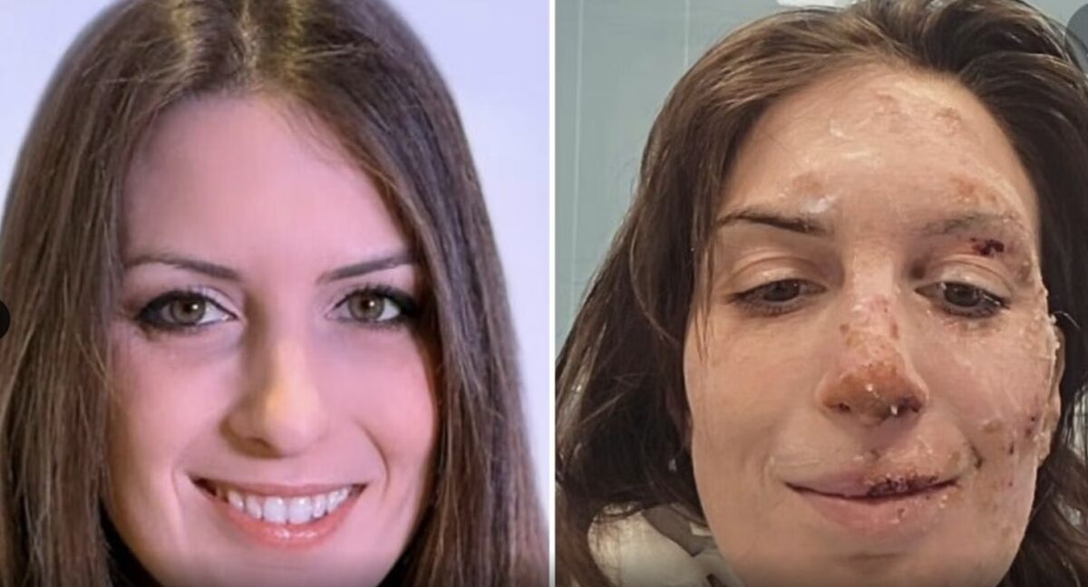 Ospedale Bufalini di Cesena: centro grandi ustionati