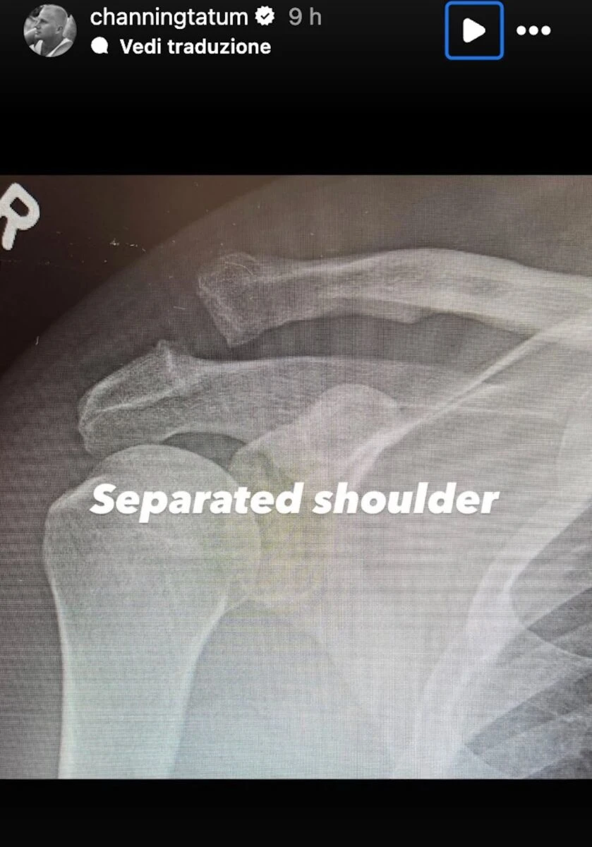 Radiografia e immagine post-operatoria della spalla di Channing Tatum
